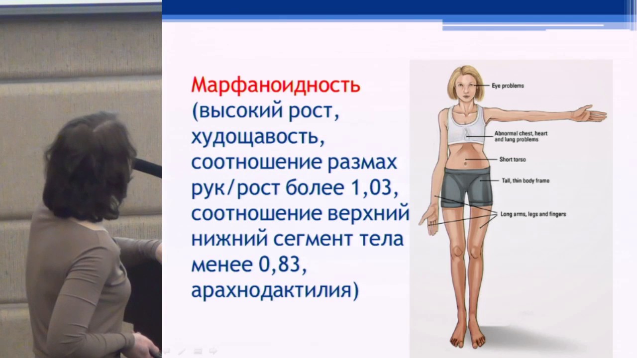 Правдюк Н. Г. Дисплазии соединительной ткани - ревматологические аспекты | Признаки симптомы лечение