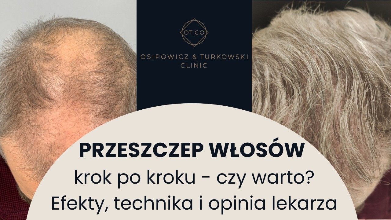Przeszczep Włosów - Cała Prawda, czy Boli, jakie daje Efekty - Dr Piotr Turkowski
