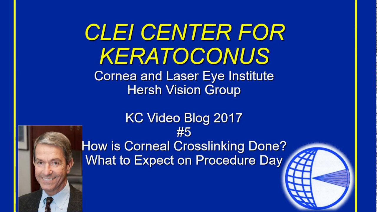 CLEI Center for Keratoconus -  How is Corneal Collagen Crosslinking Done? - Episode 5