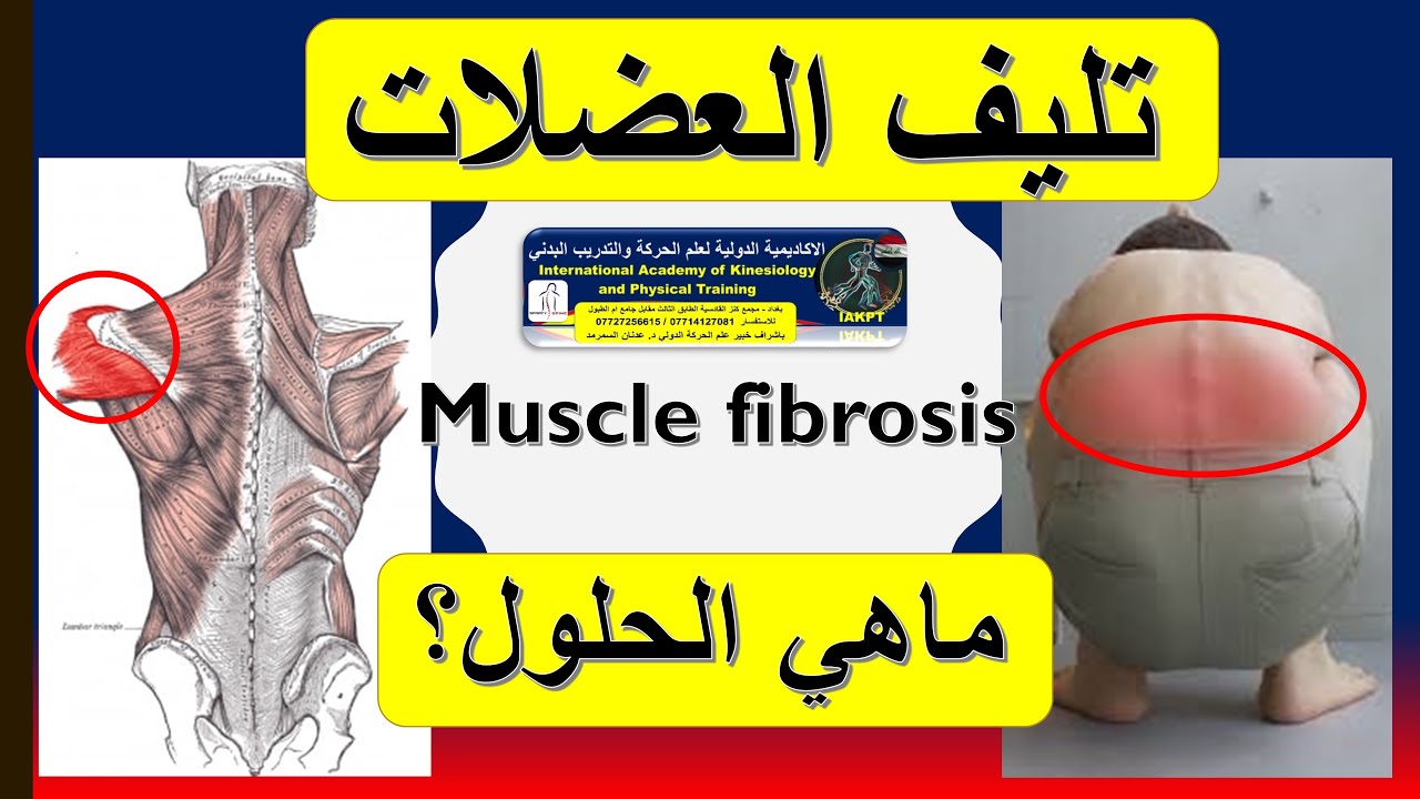 تليف العضلة مشكلة شائعة ويجب تفاديها لانها تتسبب بضرر المفصل المسؤولة عن حركته مع د. عدنان السمرمد