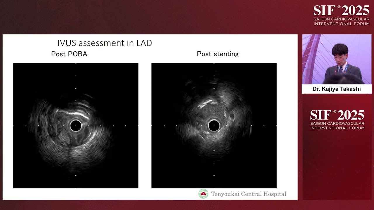 Room C- C2- Managing Guidewire and Device Entrapment in PCI