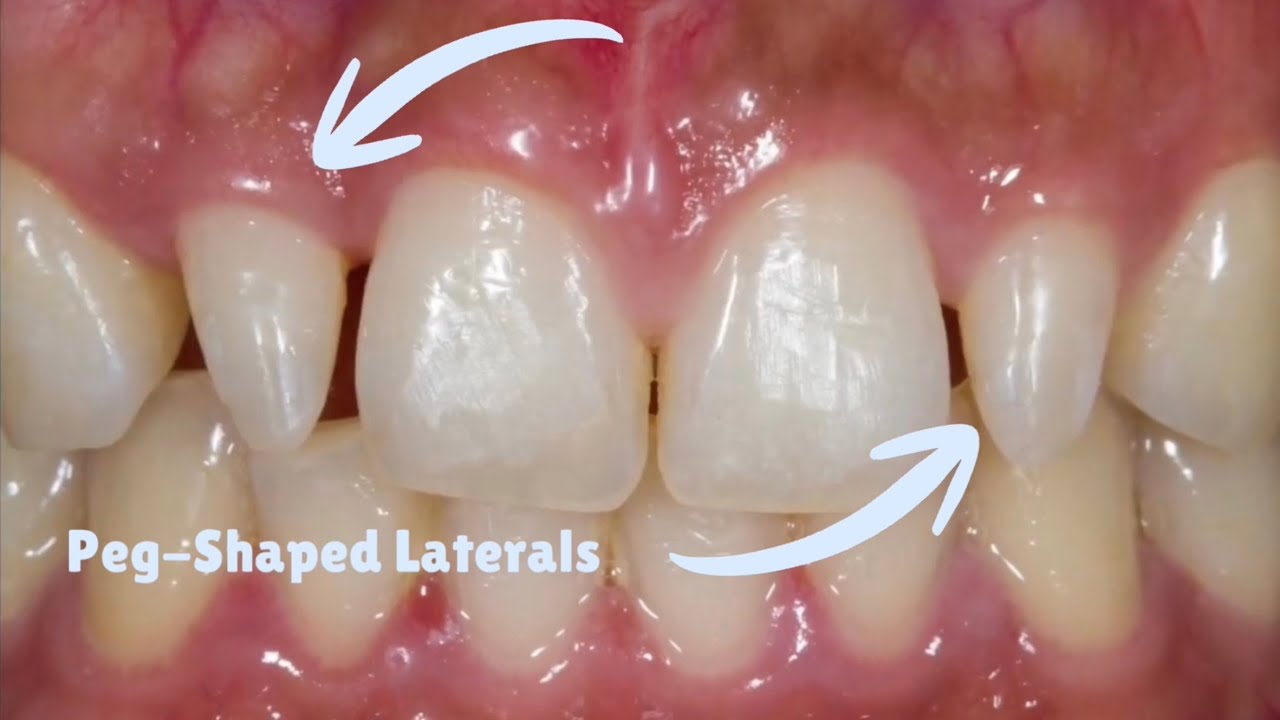 Direct Composite Restoration Of Peg-Shaped Laterals