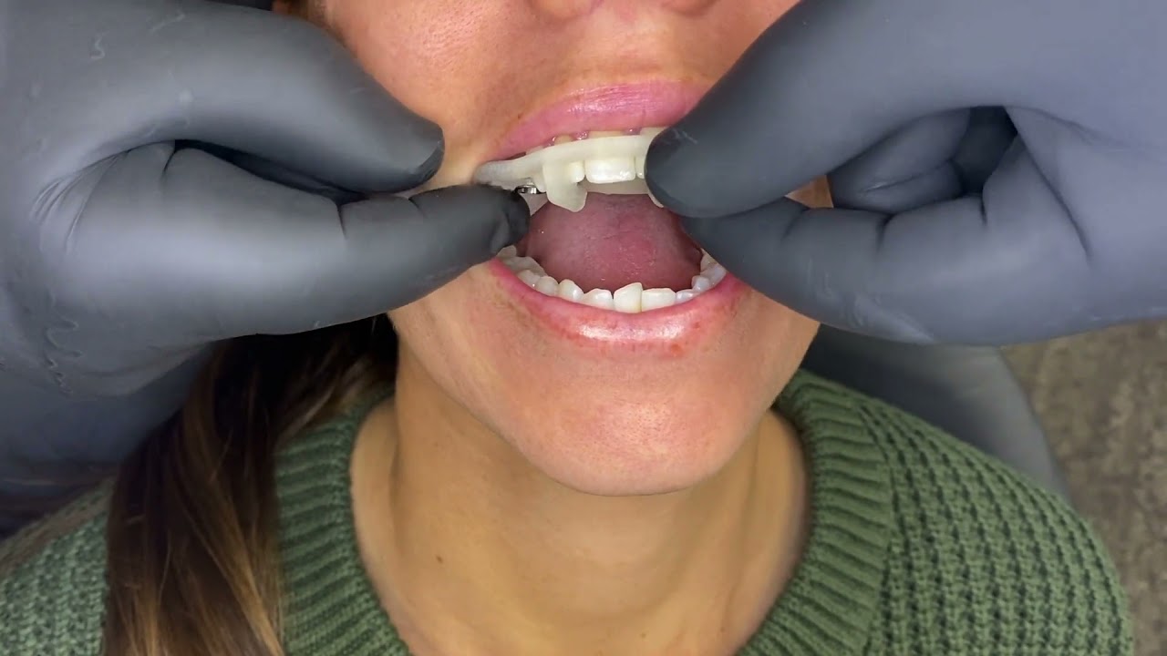 Dental Implants At The Good Dentist in Newcastle NSW