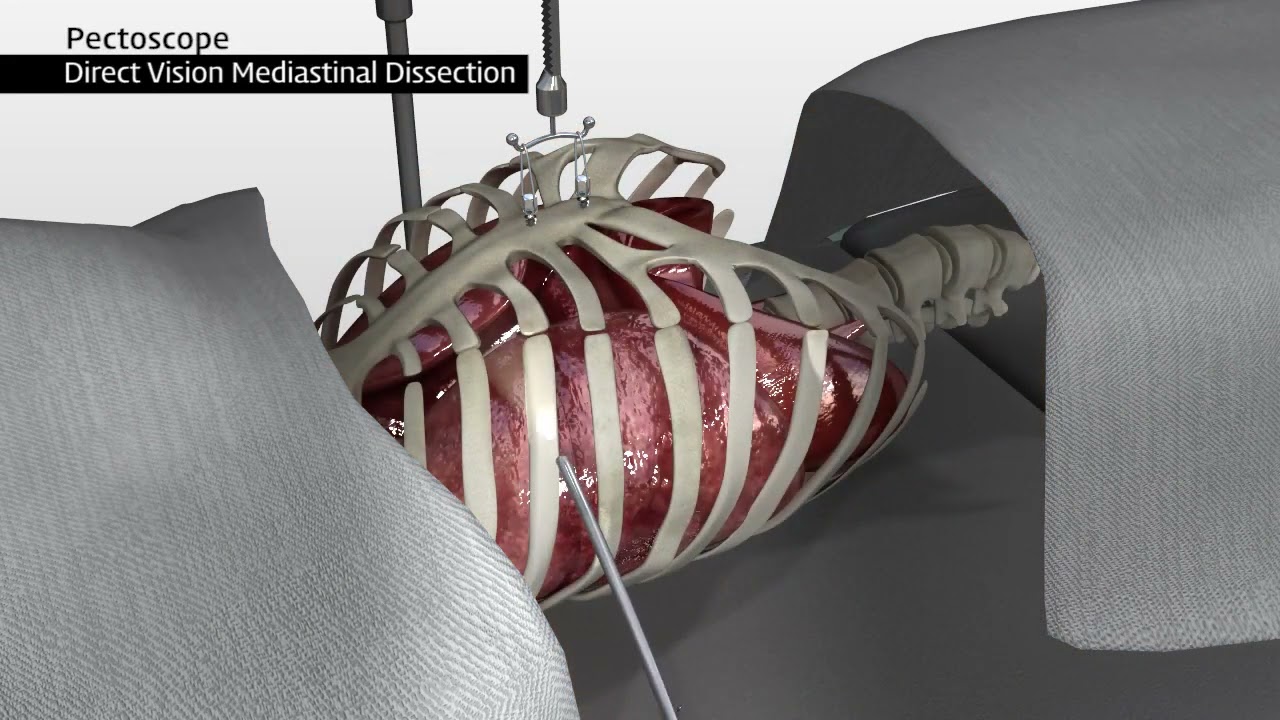 The latest pectus excavatum  surgery technique