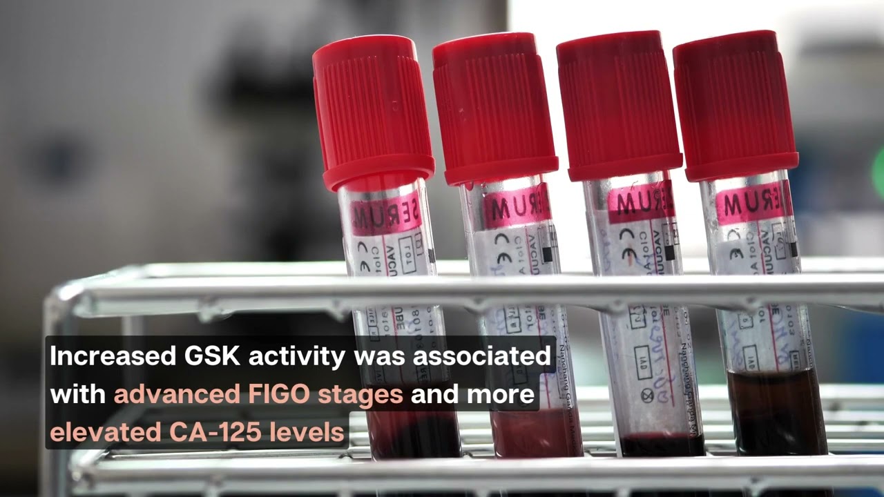 Enzyme glycogen synthase kinase in carcinogenesis, VIDEO ABSTRACT