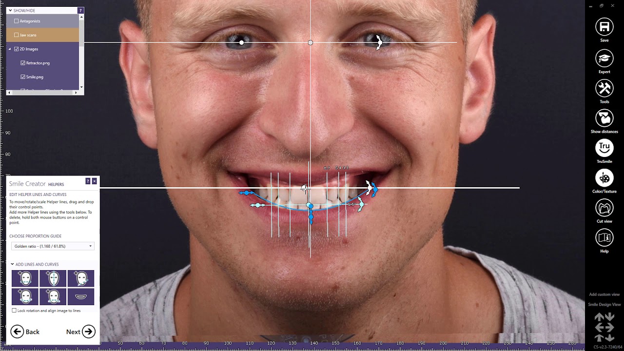exocad Smile Creator Now Integrated with Carestream Dental's CS 3600 and CS 3700 Intraoral Scanners