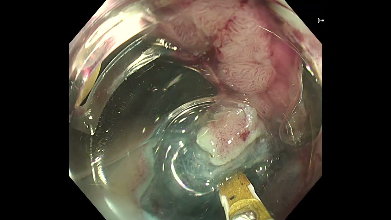 Rectosigmoid ESD Using Speedboat UltraSlim (Dr. Vega, UK)