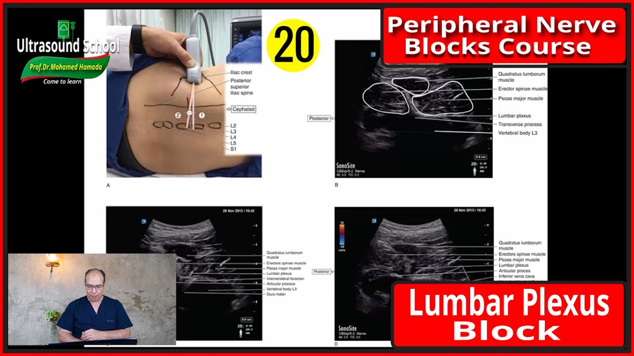 Lumbar Plexus BLock)Ultrasound Guided peripheral Nerve Blocks Course |Mohamed Hamada|(20)