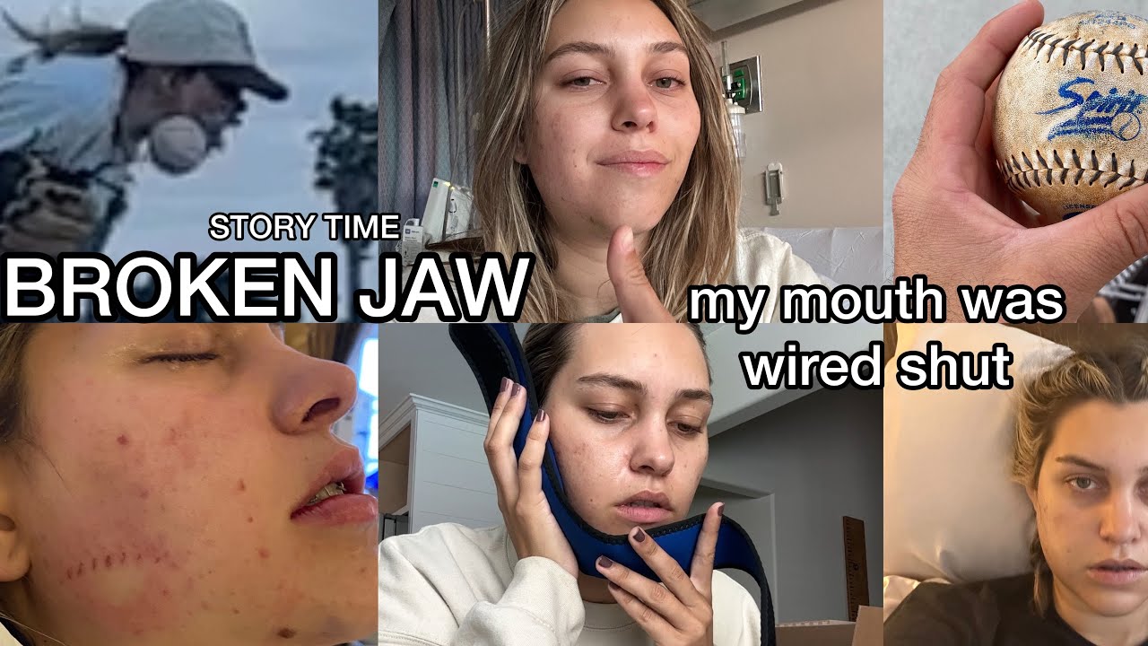 STORY TIME: Softball Accident Broke my Jaw! wired shut and surgery - San Diego, California.