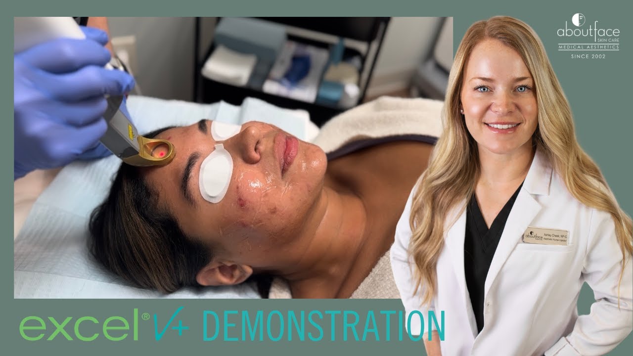 Excel V+ Laser - Global Demonstration