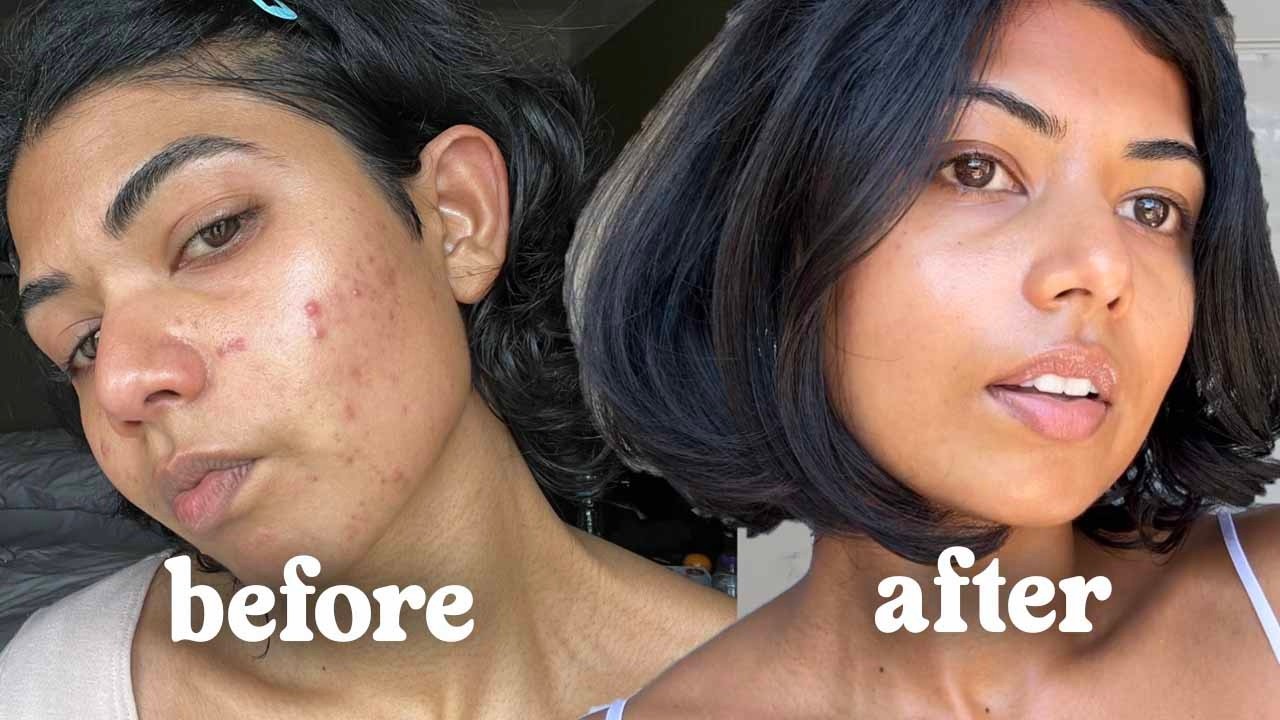 How I cleared my adult acne ☆ my skin journey