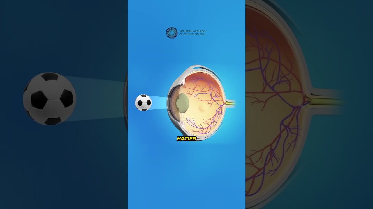 Where Do Cataracts Come From?