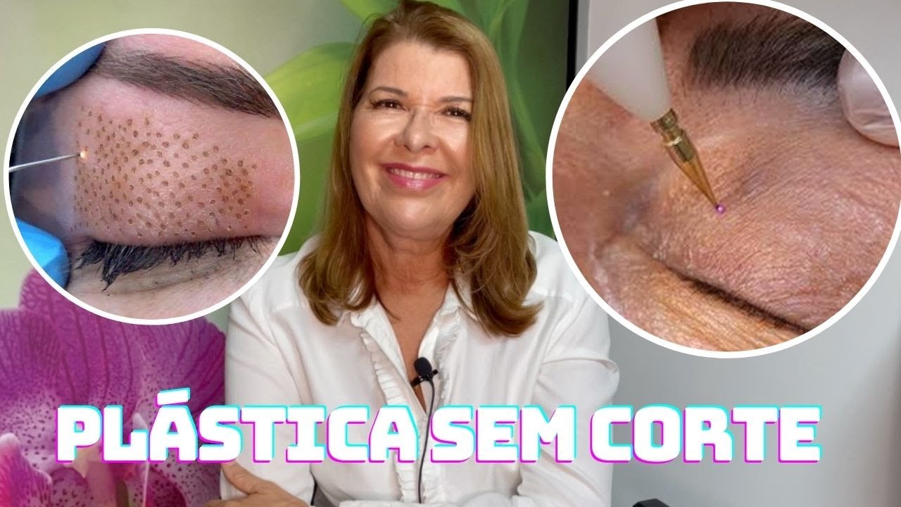 BLEFAROPLASTIA DE PLASMA: O TRATAMENTO QUE REJUVENESCE OS OLHOS