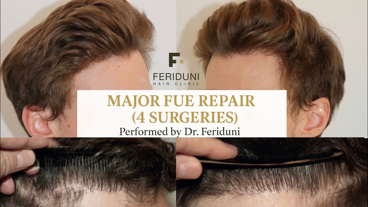 FUE Hair Transplant – Major Repair Case After a Bad Previous Procedure | Dr. Feriduni (4 Surgeries)