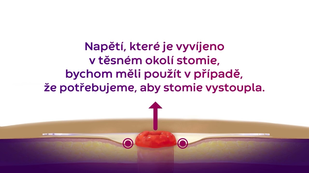 Jak fungují konvexní stomické pomůcky?