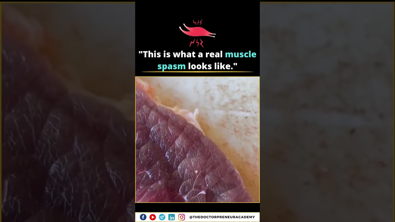 What Is a Muscle Spasm? Causes, Symptoms & Quick Relief 💥🩺
