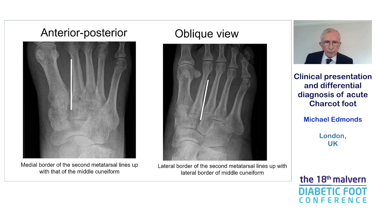 Michael Edmonds - Clinical presentation and differential diagnosis of acute Charcot foot