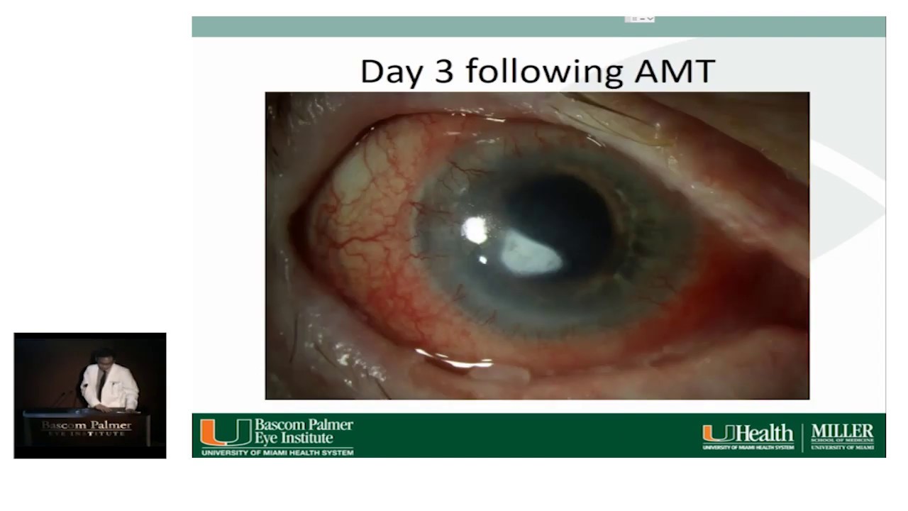 Bascom Palmer Grand Rounds Presentation by Nathan Pirakitikulr, MD, PhD