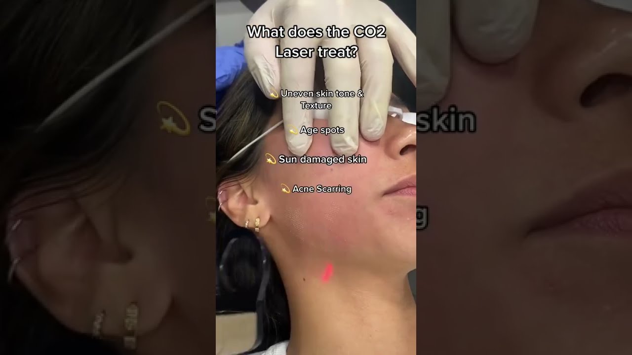 What does CO2 laser treat? | Dr. Medispa