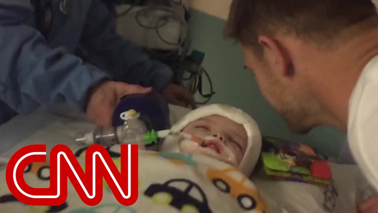Conjoined twins after surgery: Separated and a success