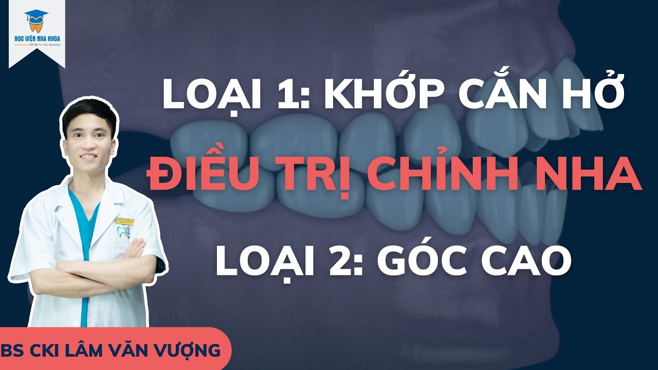 Điều Trị Chỉnh Nha Loại 1 Khớp Cắn Hở, Loại 2 Góc Cao