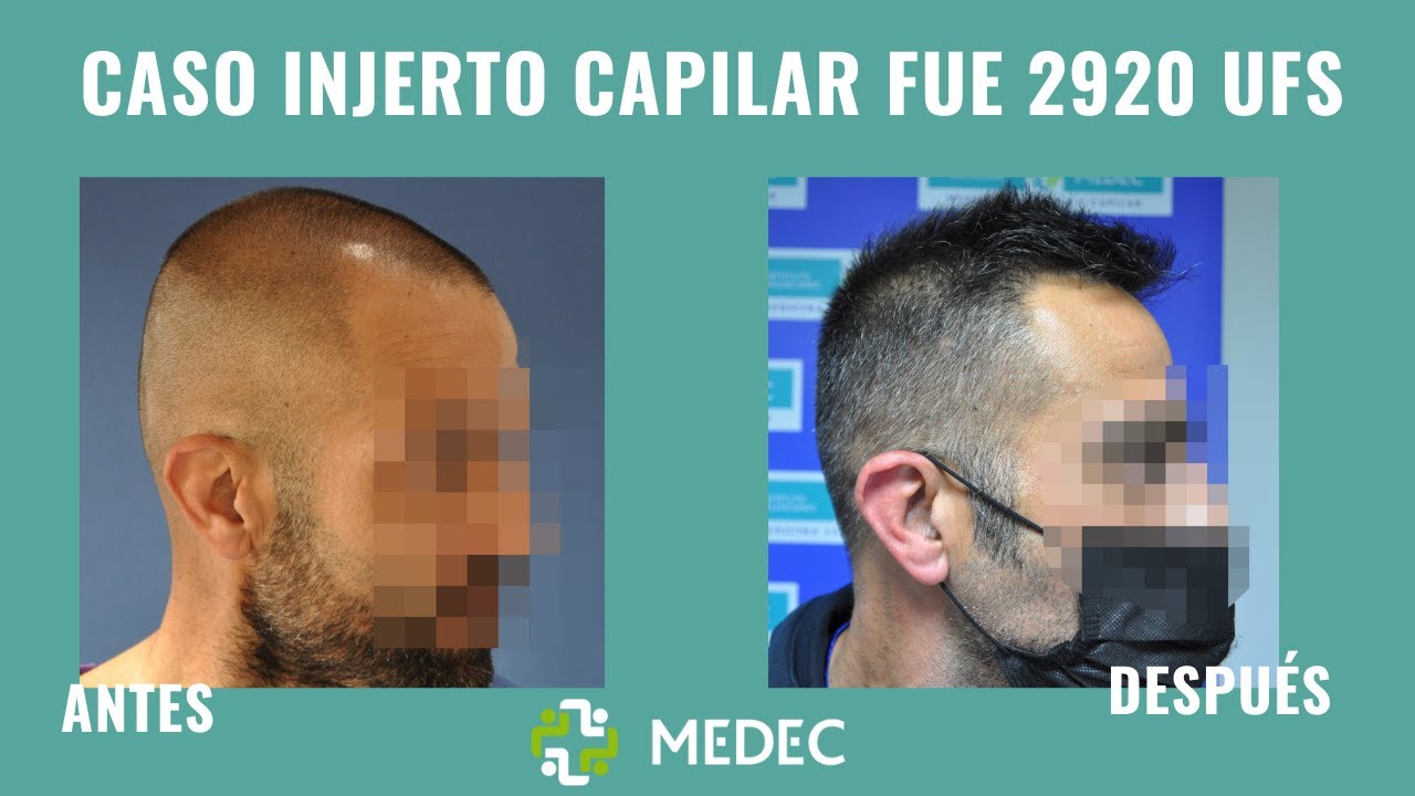 👏‍‍ CASO REAL Injerto capilar antes y después - 2920 UF´s - Resultados espectaculares