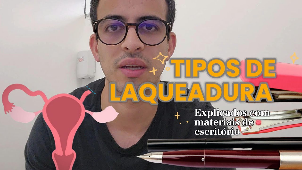 Tipos de Laqueadura: Explicados com Materiais de Escritório