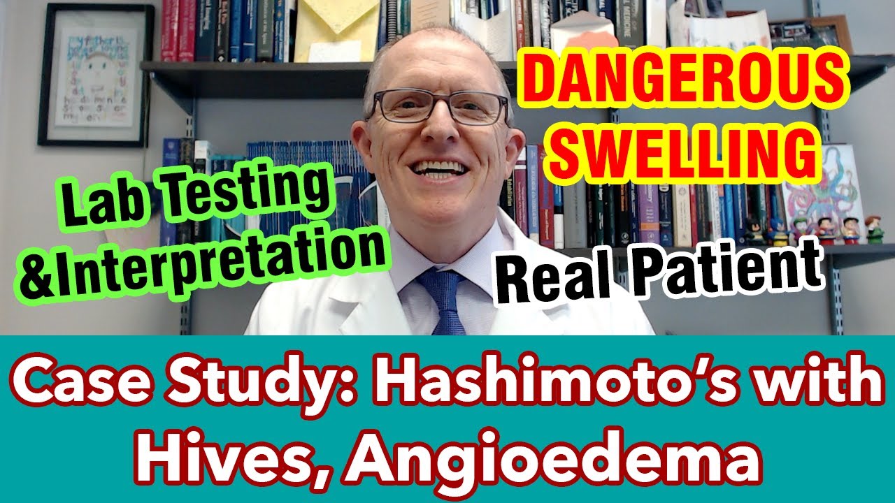 Case Study: Hashimoto's with Hives and Angioedema
