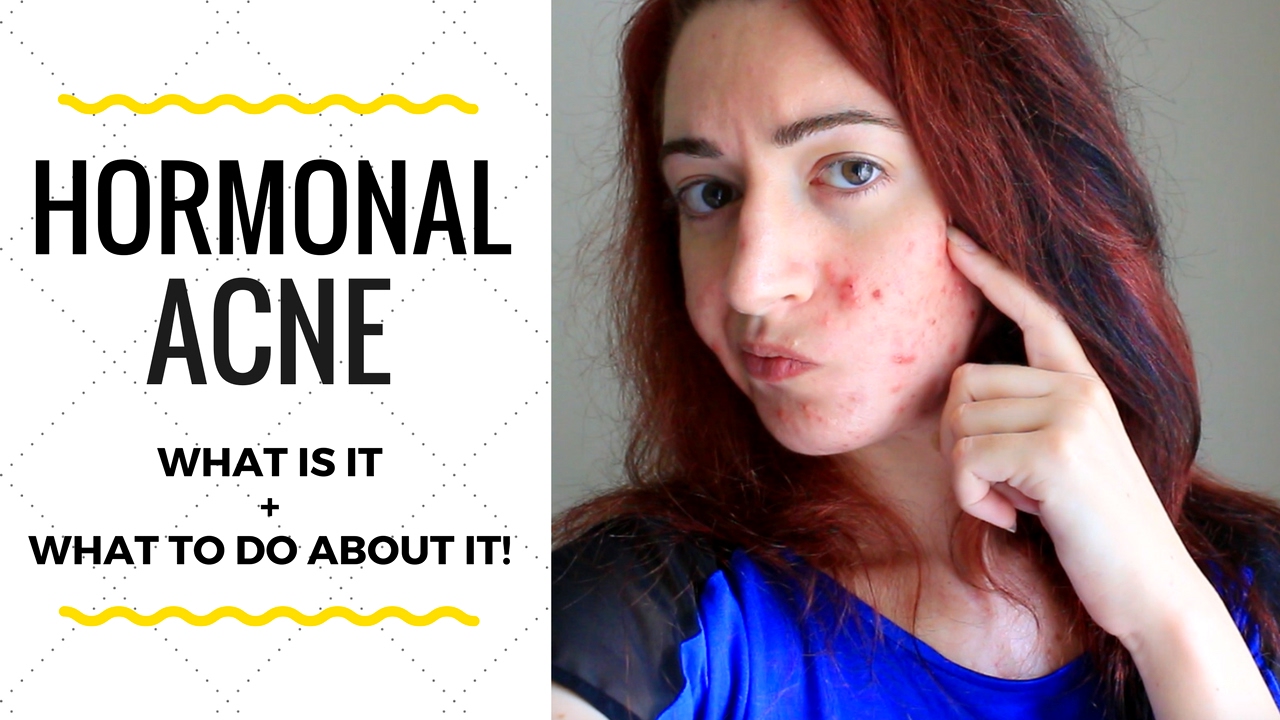 HORMONAL ACNE FACTS : What Is It, What Causes It & How To Treat it!
