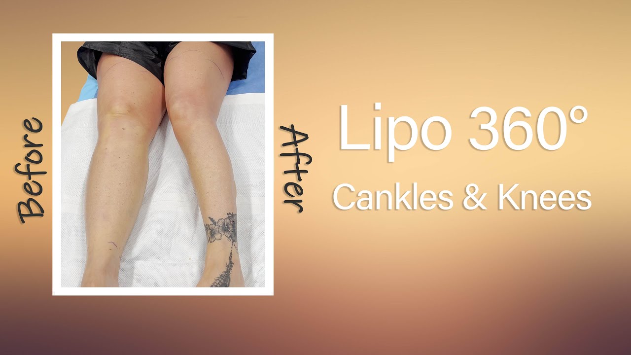 Lipo 360&deg; Legs | Cankles & Knees Liposuction | Immediate Results | Expert Dr. Thomas Su