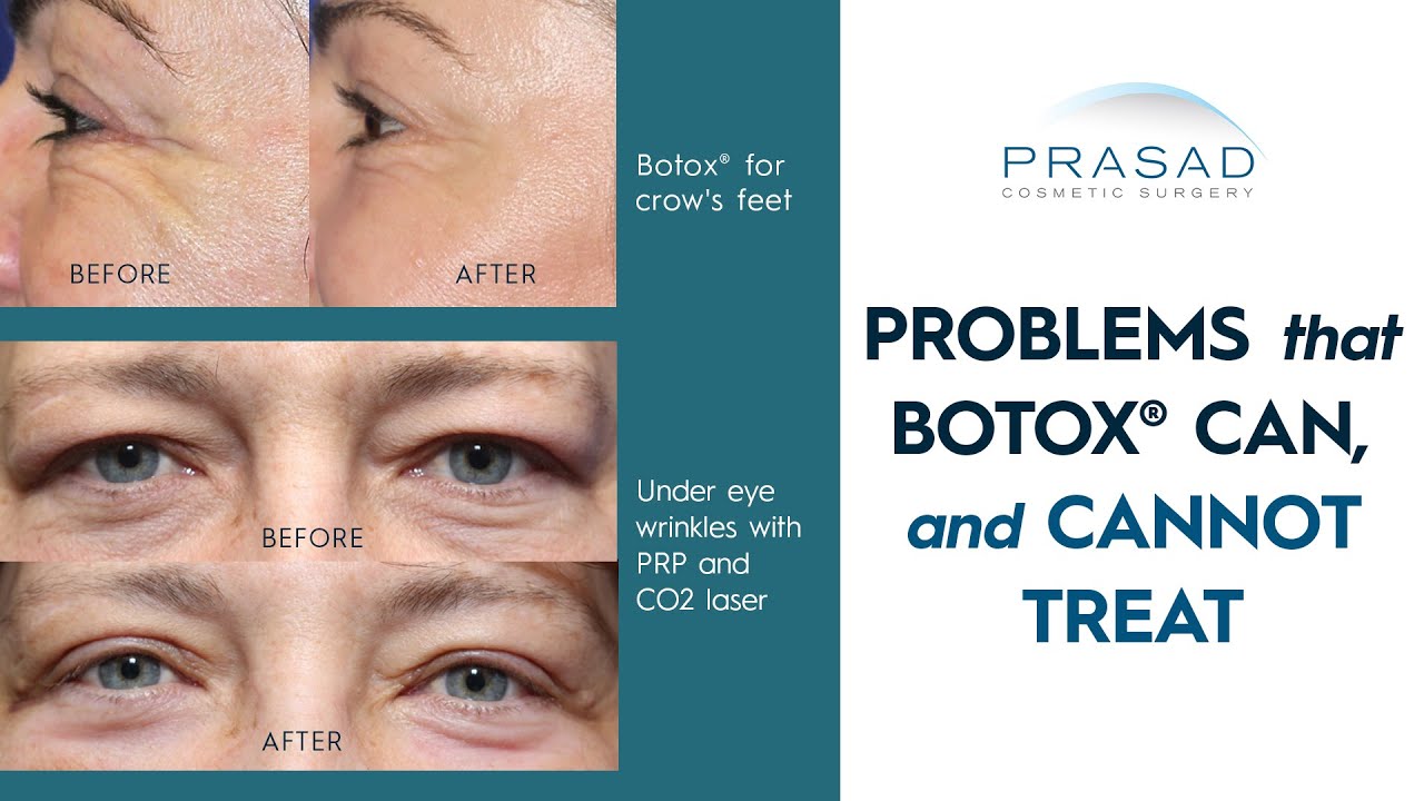 Facial Areas Botox® Can, and Cannot Treat