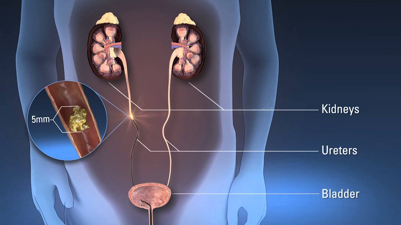 Ureteroscopy (URS)