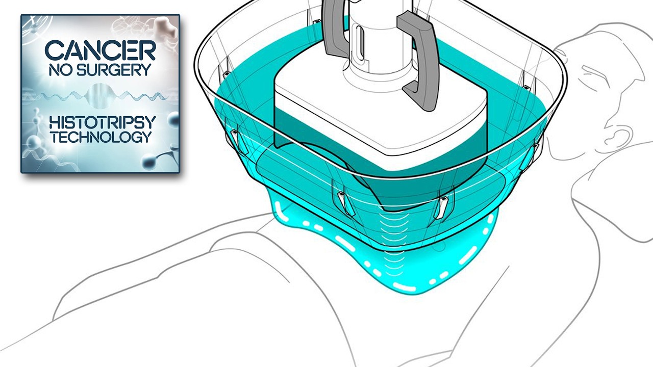 Histotripsy: Doctors Destroy Cancer Tumors With Sound