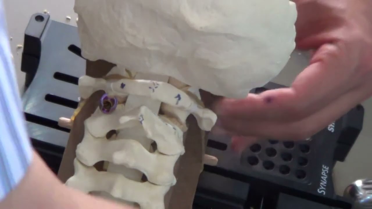 APSS Workshop: Posterior C1 C2 Fixation and Lateral Mass Fixation (6)