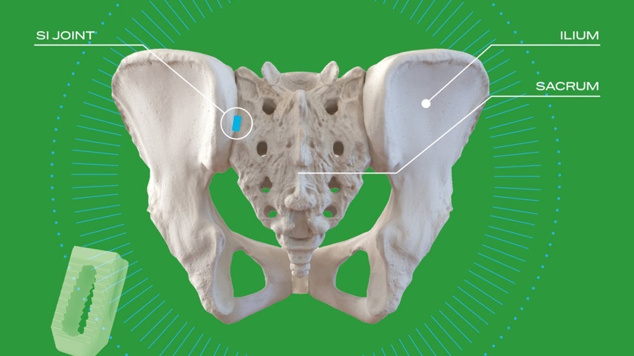 Doctors See LinQ as an Opioid-free Solution to SI Joint Pain