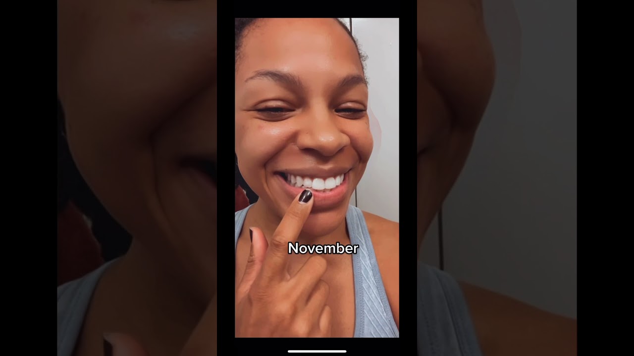 My Clear Aligners journey so far #shorts Invisalign alternative SureSmile