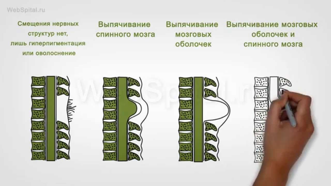 Спина бифида у детей - врождённые патологии. Внутриматочная коррекция спины бифиды