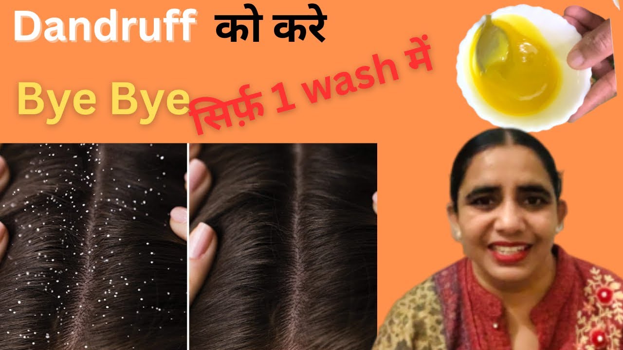 बालों से डेंड्रफ़ , खुजली और बालों का झड़ना करे दूर सिर्फ़ 1 wash से | Dandruff Parmanent Solution |