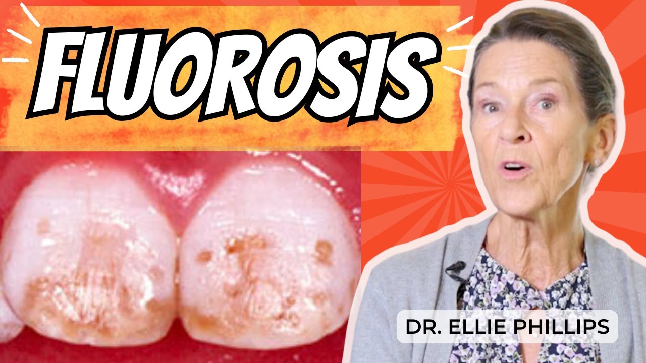 Dental Fluorosis Explained: What Causes Those Spotted Teeth?