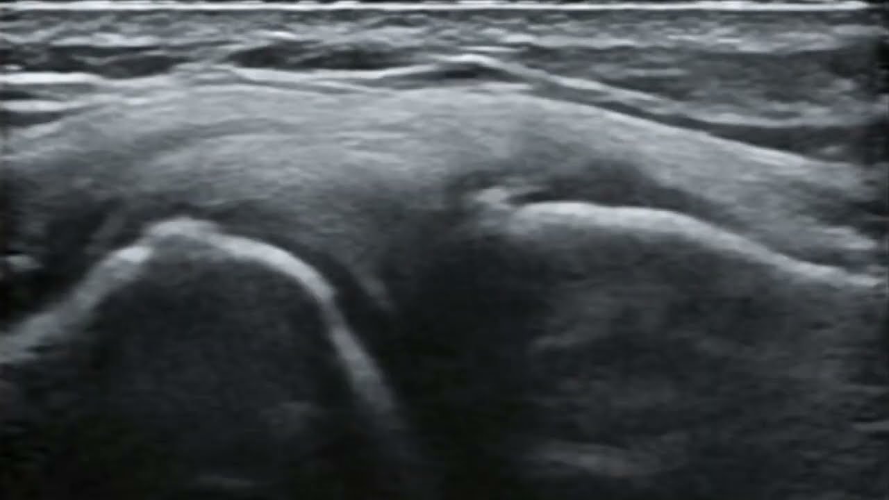 Medial meniscus extrusion - dynamic ultrasound examination