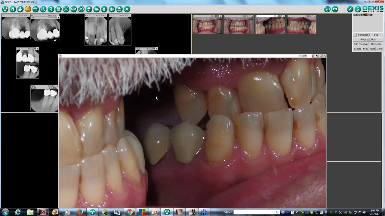 Multiple Posterior Implants  Treatment Planning and Case Presentation