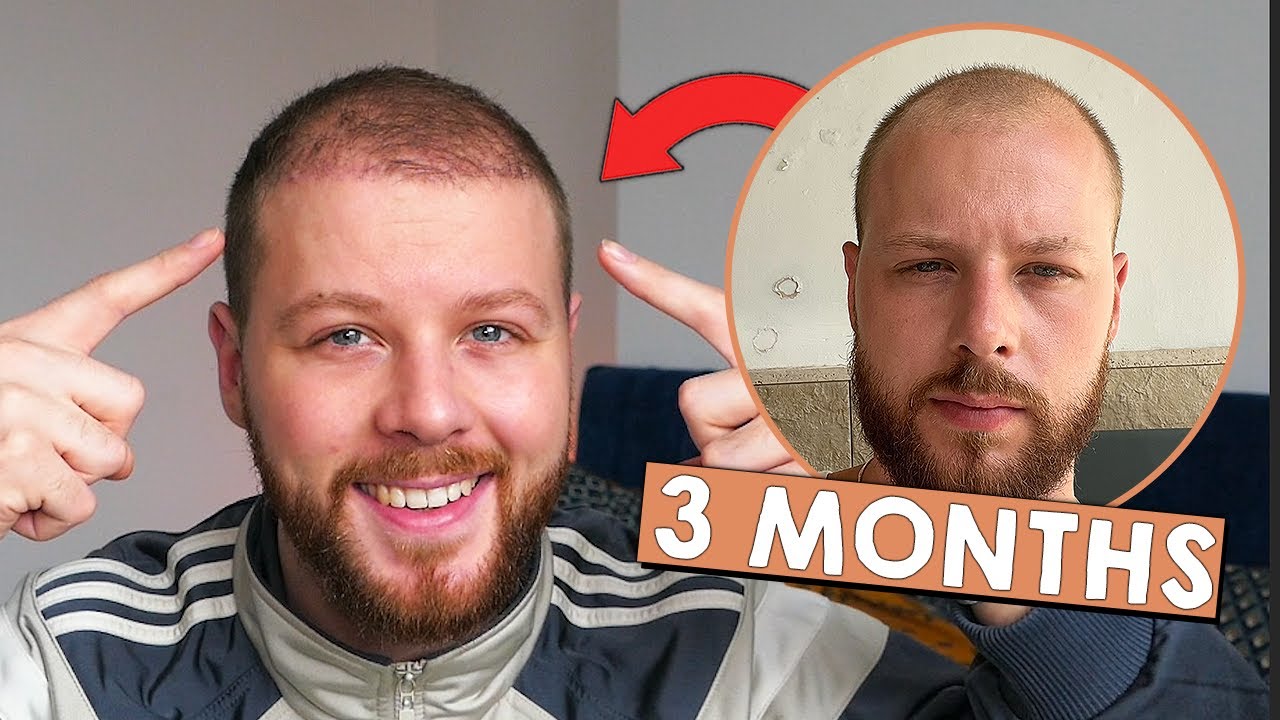 Стоит ли делать пересадку волос? | МОИ РЕЗУЛЬТАТЫ ЗА 3 МЕСЯЦА @SmileHairClinic