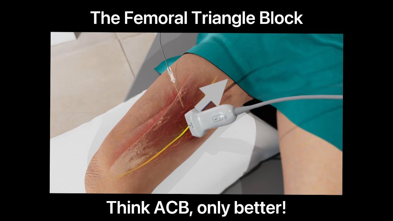Ultrasound-Guided Femoral Triangle Block / Step by Step Regional Anesthesia tutorial by PNBschool