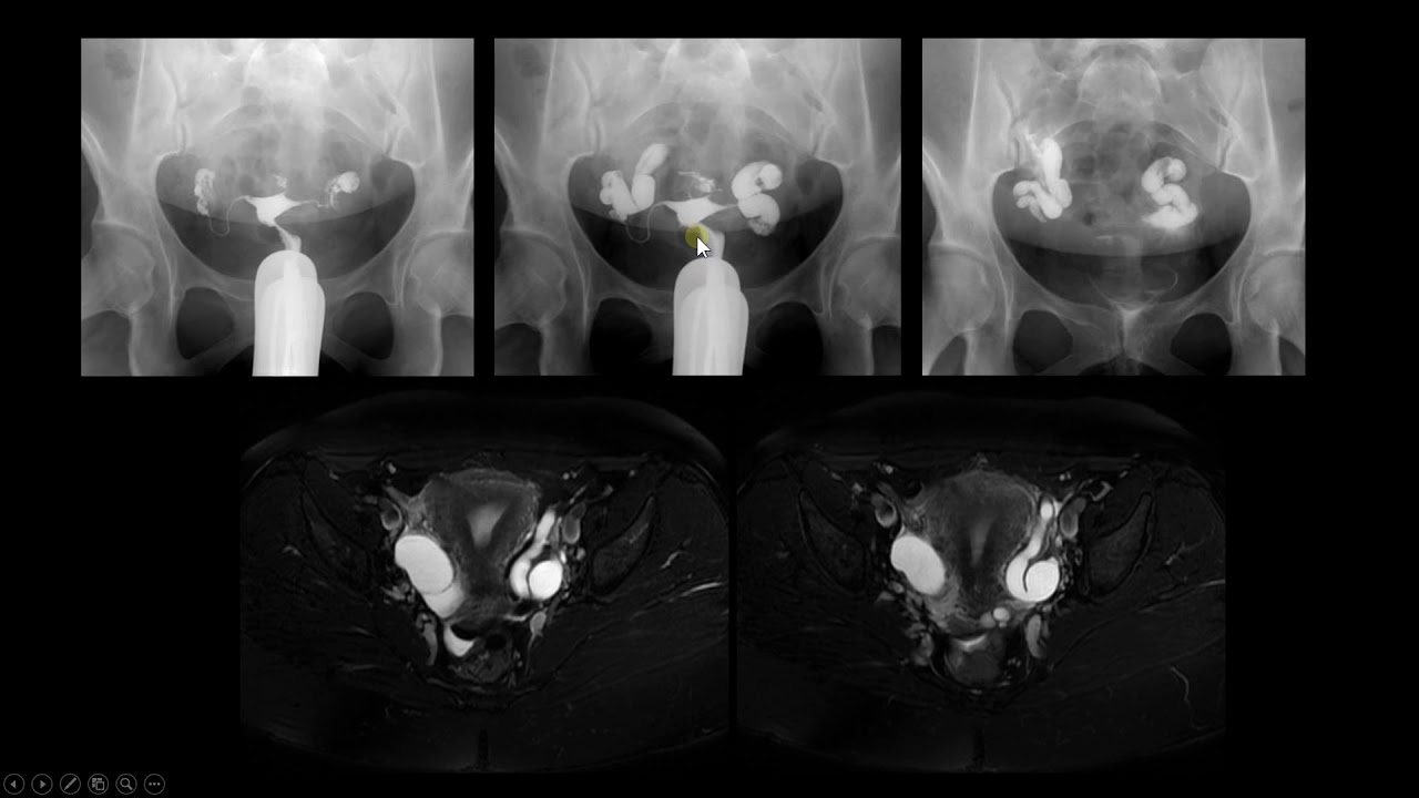 Hidrossalpinge bilateral