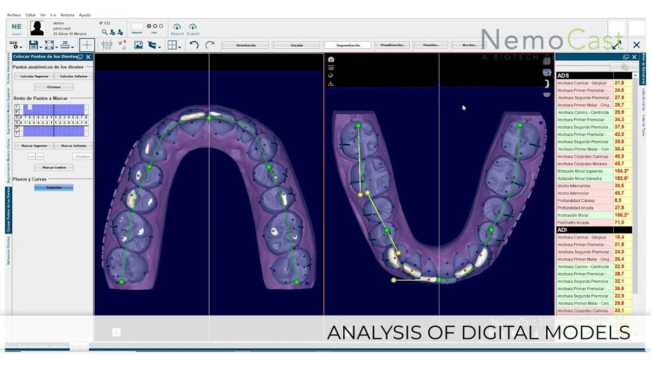 NemoCast Demo - The major breakthrough in digital orthodontics_English
