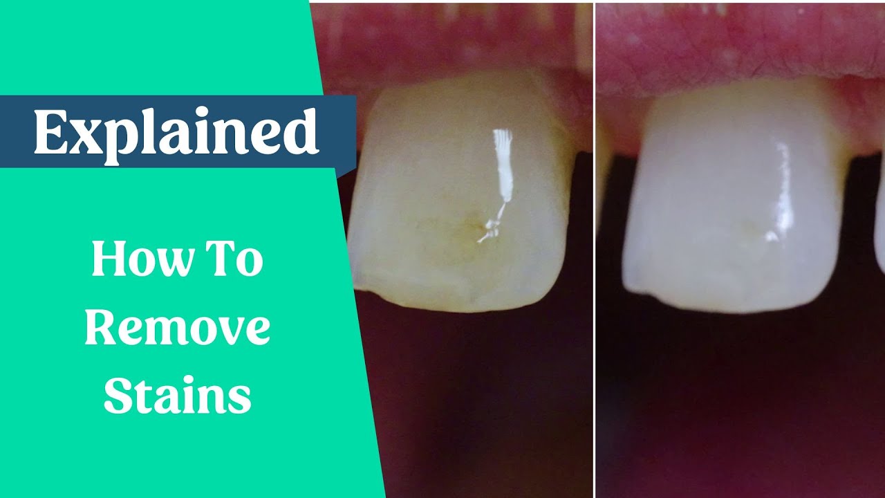 How To Remove Stains From The Teeth