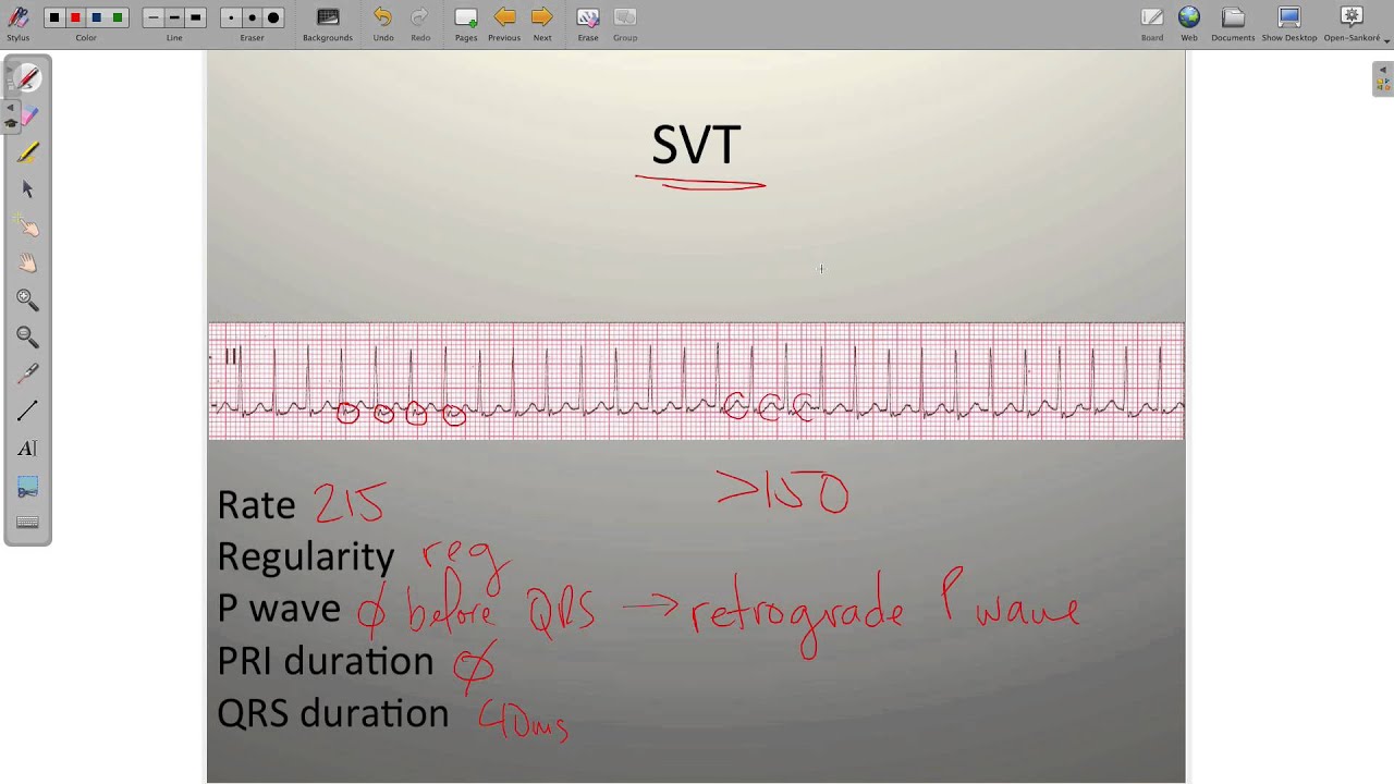 ECG Atrial Rhythms AF AFRVR SVT PAC