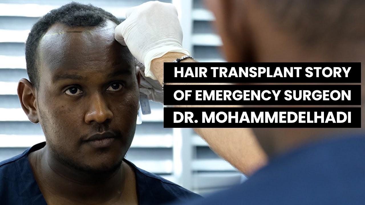 AFRO HAIR TRANSPLANT IN TURKEY | Hair Transplant Story of Emergency Surgeon DR.MOHAMMEDALHI