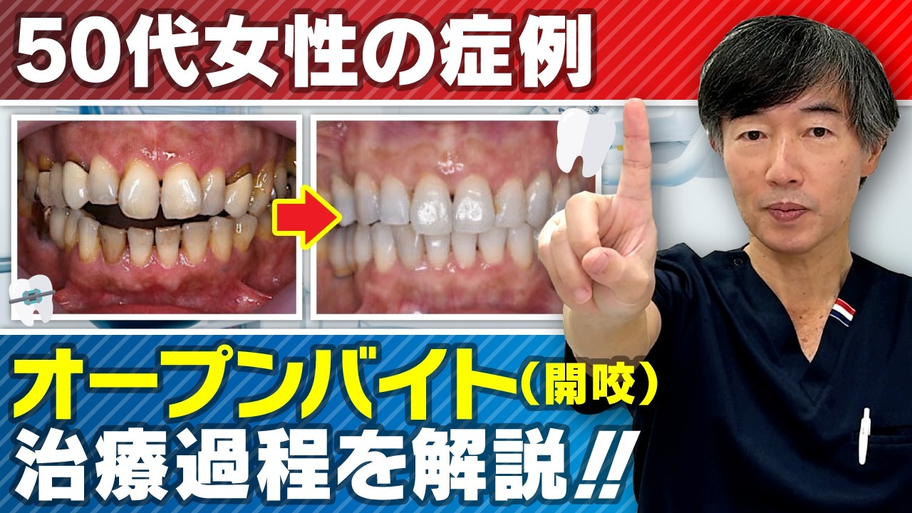 【症例動画｜50代女性】前歯が噛まない…噛めない状態はこう治りました！