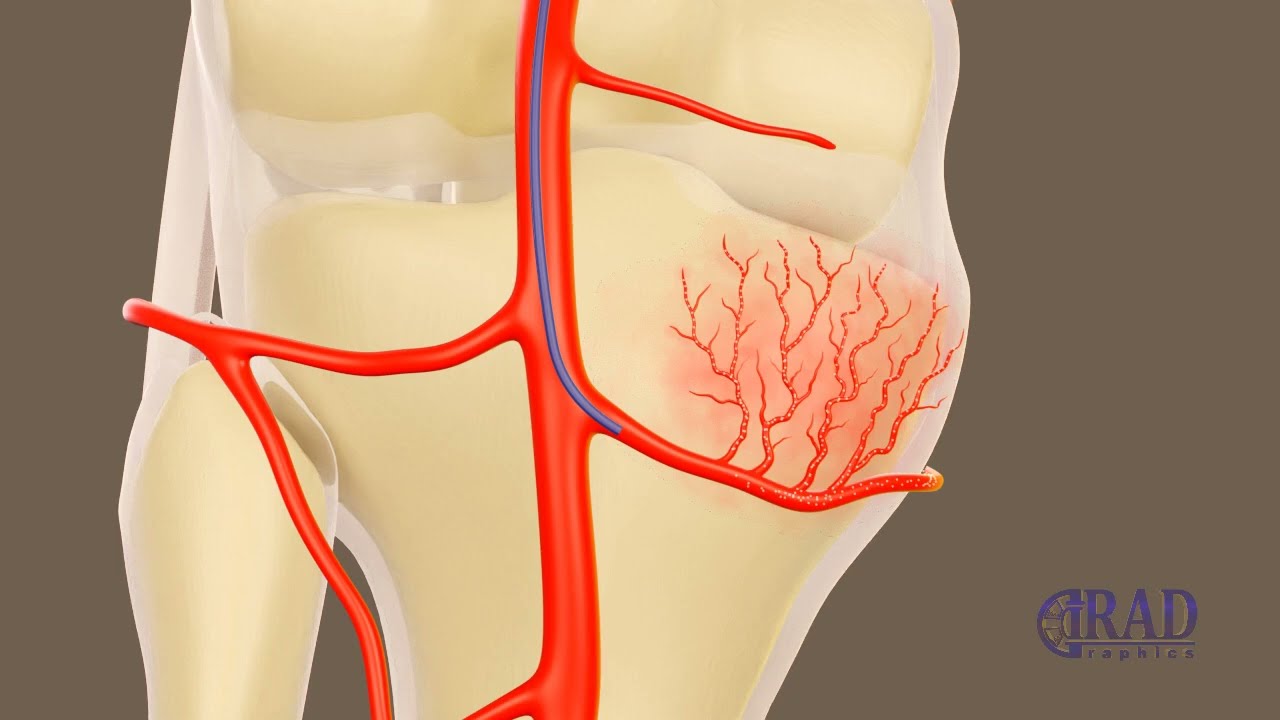 GAE Procedure for Arthritic Knee Pain in Pittsburgh